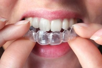 Ortodoncia Invisible (Invisalign) - Murcia | Clínica Dental Ángel Samaniego