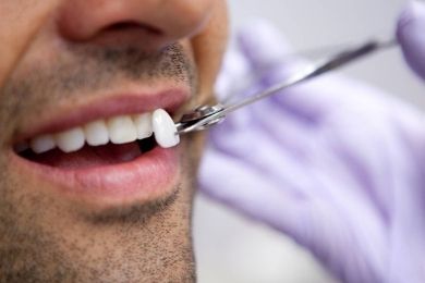 Carillas Dentales - Estética Dental en Murcia | Clínica Dental Ángel Samaniego