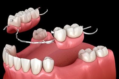 Prótesis Removibles | Clínica Dental Ángel Samaniego